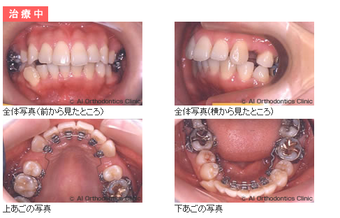 矯正治療中