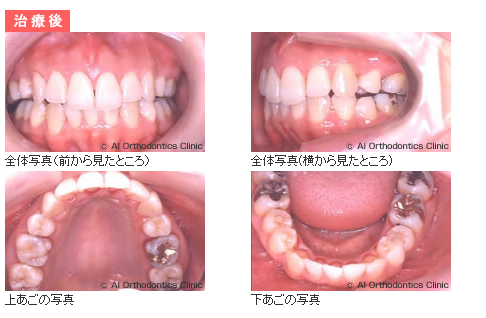 ■矯正治療後～メインテナンス