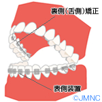 大人の矯正（成人矯正/2期治療）