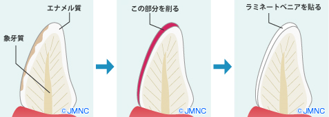 ラミネートベニア