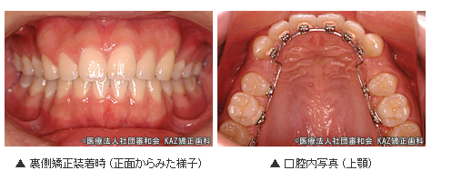 裏側矯正(舌側矯正)装着時の様子