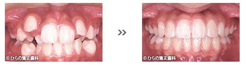 八重歯(乱杭歯）の矯正治療