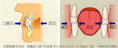 歯列に対する内方圧と外方圧