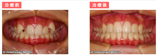 治療前と治療後の口元に比較