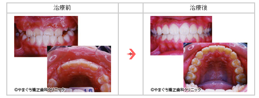 反対咬合(はんたいこうごう)