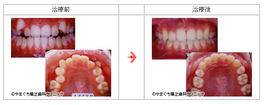 側方開咬(そくほうかいこう)