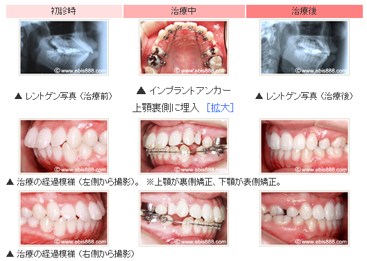  上下顎前突（出っ歯）をインプラント矯正で治療した例