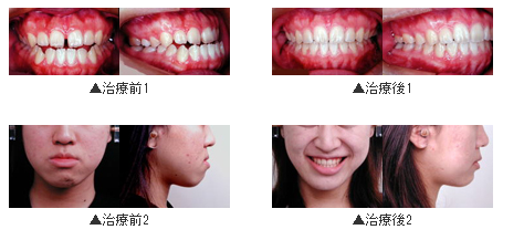 成人下顎前突 ［せいじんかがくぜんとつ］ （顎変形症）