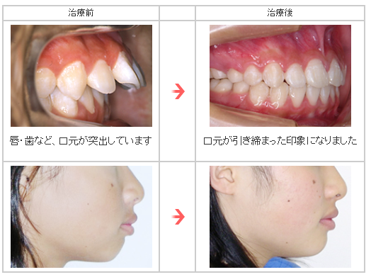 成人矯正(永久歯が生え揃った方)の治療例