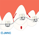 マルチブラケット矯正