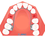 リンガルアーチ　（舌側弧線装置）