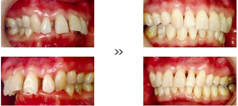歯並びが悪いとどうなるの 2 矯正と歯の寿命と矯正 矯正歯科ネット