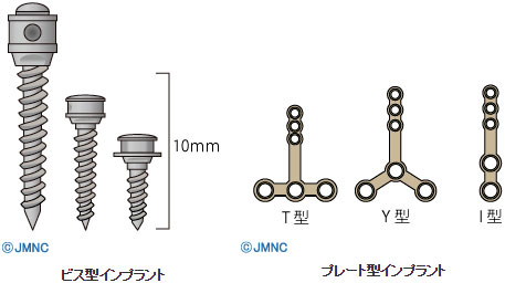 矯正用インプラント(インプラントアンカー)とは