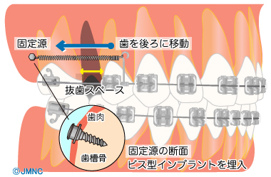 矯正用インプラントで歯が動きやすくなる訳とは