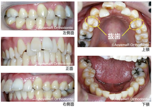 マウスピースで出っ歯を治療した症例 成人矯正 矯正歯科ネット