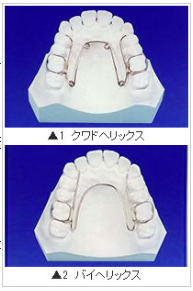 拡大装置 緩除拡大装置とは 矯正歯科ネット