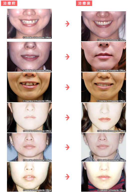 矯正治療前後のお顔の変化 輪郭 口もとの変化 矯正歯科ネット