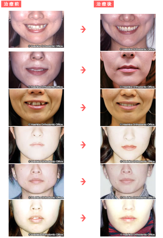 歯 列 矯正 顔 の 変化