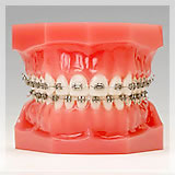 歯列矯正に多く用いられる最もオーソドックスな装置 メタルブラケット