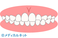 交叉咬合 （こうさこうごう）