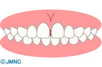 すきっ歯・正中離開（せいちゅうりかい）