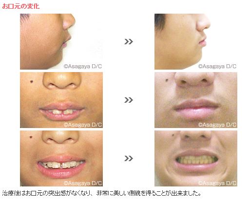 著しい上顎前突 過蓋咬合 成長を利用した非抜歯症例 矯正歯科ネット