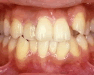 A.でこぼこ、乱杭歯[らんくいば]、八重歯