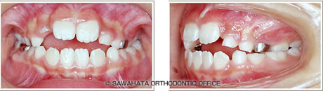 【開咬の症例1】 小児矯正の治療例治療前
