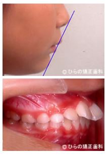 出っ歯（上顎前突）の矯正の症例治療前