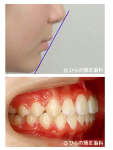 出っ歯（上顎前突）の矯正の症例治療後