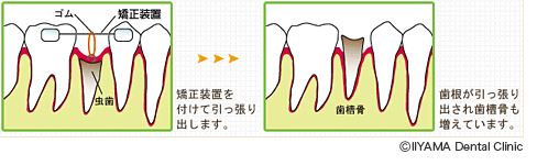 引っ張り出し（エキストリュージョン）による治療例