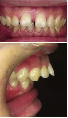 骨格性上顎前突・過蓋咬合・空隙歯列弓（正面）　治療前治療前
