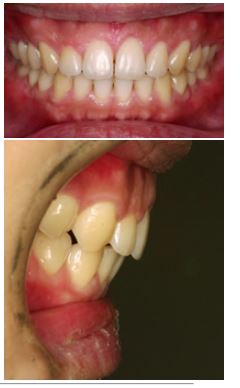 骨格性上顎前突・過蓋咬合・空隙歯列弓（正面）　治療前治療後
