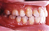 骨格性下顎前突・前歯部反対咬合・叢生　治療後治療後