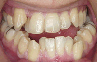 骨格性下顎前突・前歯部開咬・叢生　治療前治療前