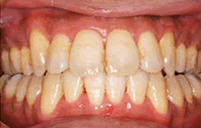 骨格性下顎前突・前歯部開咬・叢生　治療前治療後