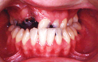 右側唇顎口蓋裂　狭窄歯列弓・　前歯部反対咬合治療前