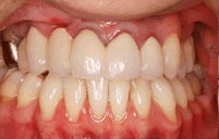 右側唇顎口蓋裂　狭窄歯列弓・　前歯部反対咬合治療後