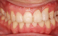左側唇顎口蓋裂　狭窄歯列弓・　叢生　治療前治療後