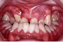 両側性唇顎口蓋裂　狭窄歯列弓・臼歯部交叉咬合および前歯部反対咬合治療前治療前