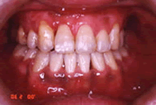 両側性唇顎口蓋裂　狭窄歯列弓・臼歯部交叉咬合および前歯部反対咬合治療前治療後