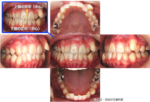 歯を抜かない矯正の症例（治療前）
