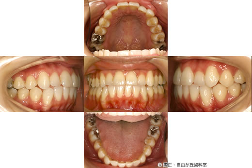 歯を抜かない矯正の症例（治療完了から5年後）