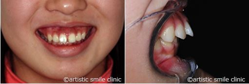 治療例1　出っ歯とガミースマイルを矯正で改善したケース治療前