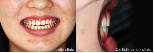 治療例1　出っ歯とガミースマイルを矯正で改善したケース治療後