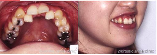 治療例2　デコボコの歯並びとガミースマイルを改善したケース治療前