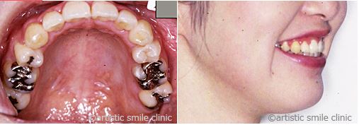 治療例2　デコボコの歯並びとガミースマイルを改善したケース治療後