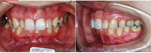治療例3　過蓋咬合とガミースマイルを改善したケース治療前