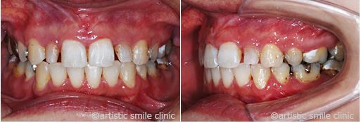 治療例3　過蓋咬合とガミースマイルを改善したケース治療中