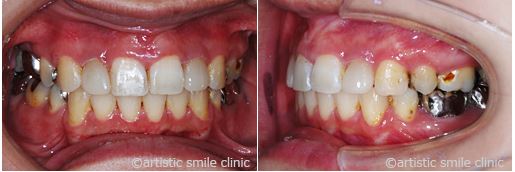 治療例3　過蓋咬合とガミースマイルを改善したケース治療後